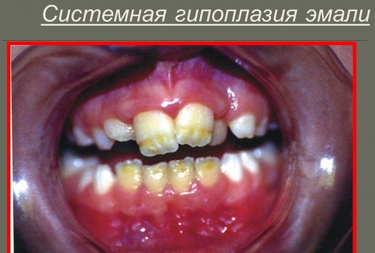 Onvolmaakte dentinogenese en amelogenese - een schending van de structuur van dentine en glazuur