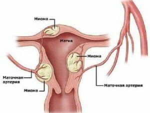 The difference between fibromyoma and myoma