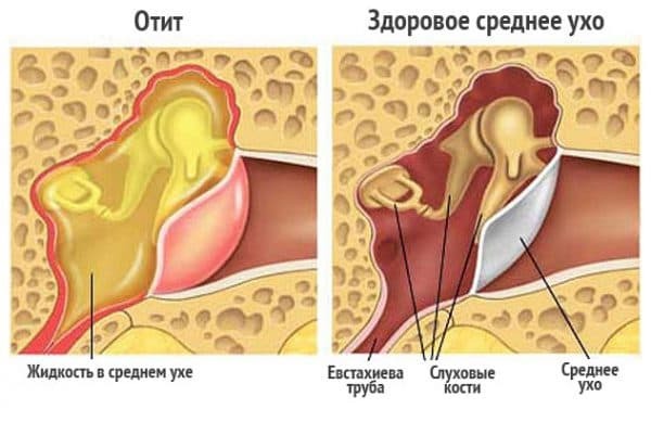 externe diffuse otitis media