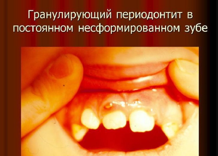 Chronic granulating periodontitis in the stage of exacerbation and remission