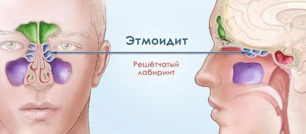 ethmoiditis