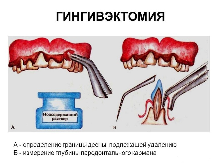 Gingivektomi - eksisi operasi kantong periodontal