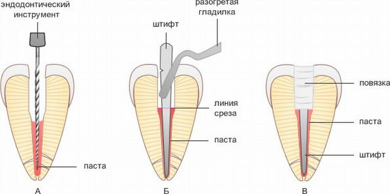 Штифт это. Пломбирование корневых каналов методом одного штифта. Штифт стоматологический для пломбирования корневых каналов. Пломбирование каналов методом 1 штифта. Этапы пломбирования корневых каналов.