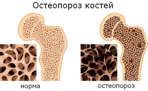 Pencegahan osteoporosis saat menopause