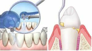 Skalowanie powierzchni korzenia i poddziąsłowa - gwarancja zdrowia i urody zębów