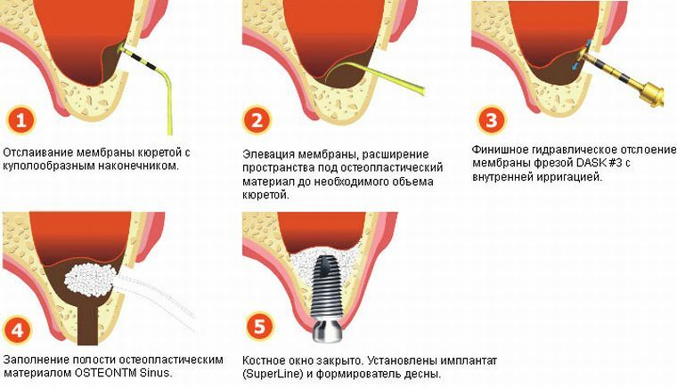 Wat is de opheffing van de sinussen en wat is de rol ervan bij de implantatie van tanden
