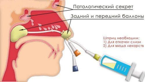 acute vorm van ethmoiditis