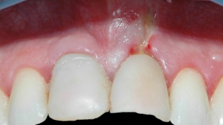 Qual é a perfuração do dente e quão perigoso é o orifício na raiz e área da coroa