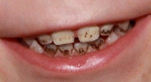 Pontos pretos nos dentes - é sempre cárie?