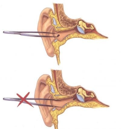 foreign body in the ear