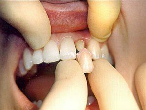 Le migliori corone per l'installazione sui denti anteriori