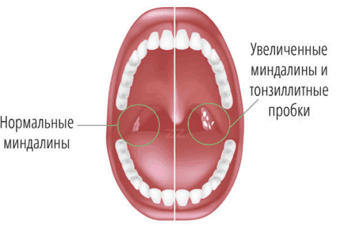 bacterial tonsillitis