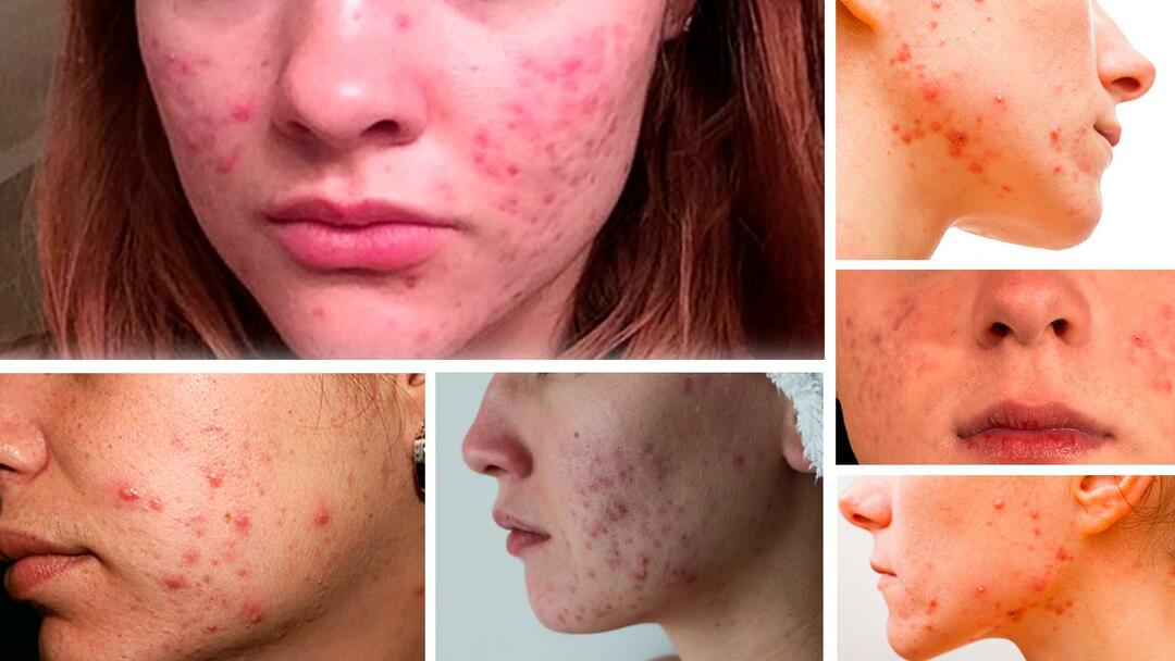 acne and acne treatment