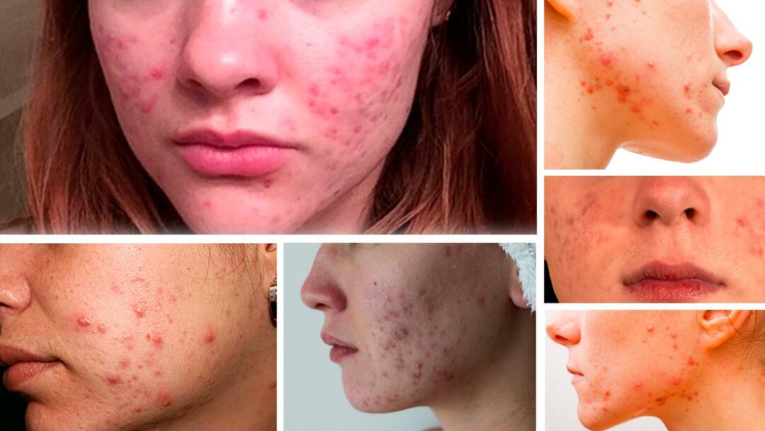 Anticonceptie, hormonale pillen voor acne (hulp of niet)