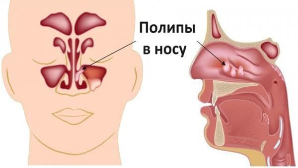 polypy v príznakoch nosa a liečbe