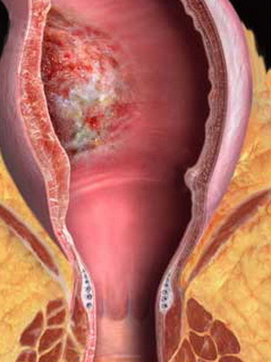 Postpartum perineal ulcer: symptoms, diagnosis, treatment