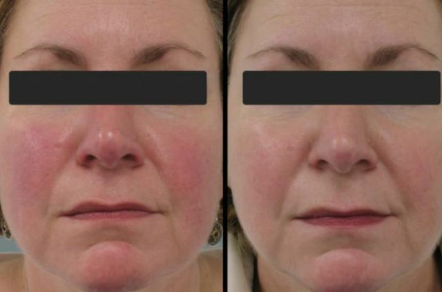 Cortex Cream - capilaroprotector para proteger la piel de la cara de la cuperosis