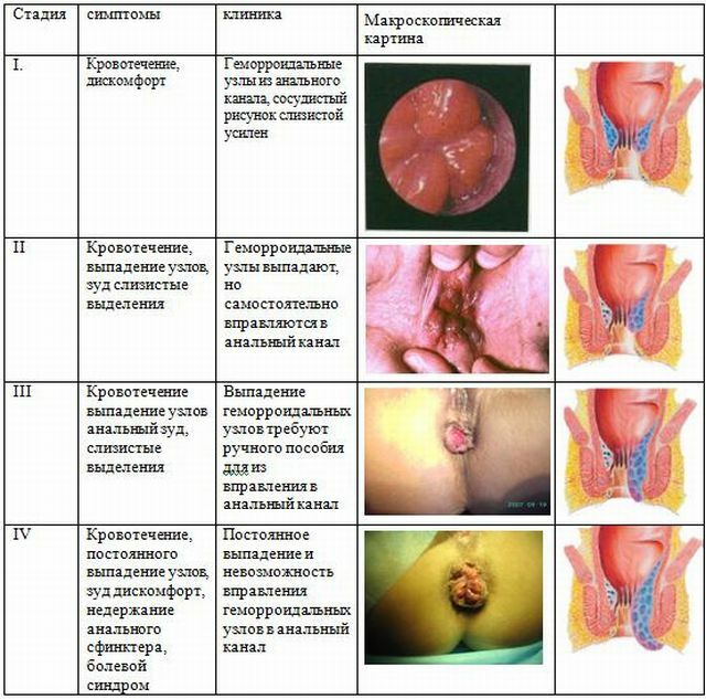 Objawy hemoroidów