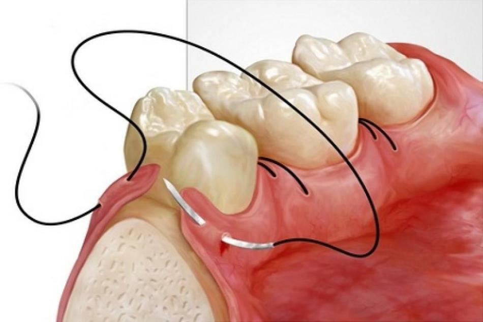 Em que dia são as suturas removidas após cesariana, laparoscopia, apendicite, episiotomia, remoção, implantação do dente, colo do útero, hérnia, feridas no braço, perna e face?É doloroso remover pontos depois da cirurgia, parto, laparoscopia?