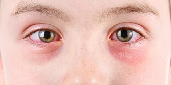 Gotas oculares baseadas em ofloxacina