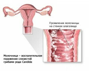 Thrush( candidiasis) with menstruation