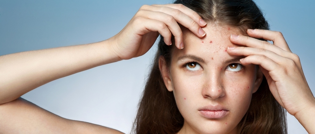Hormonel acne og acne behandling (hormon og acne link)