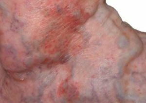 eczema varicoso nas pernas