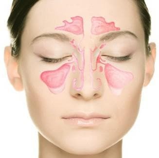 bilateral sinusitis acute form