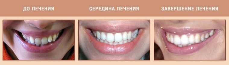 Klammern auf Zähnen: Termin, Art, Installation