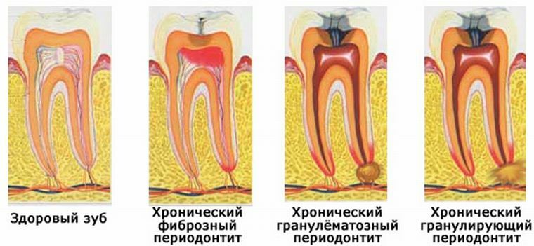 Penyebab, gejala dan pengobatan periodontitis kronis