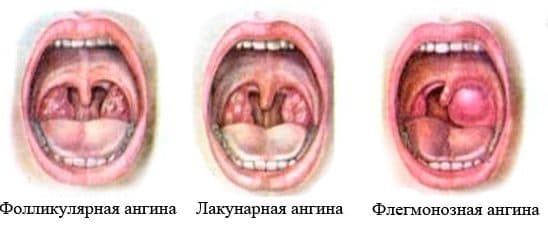 lacunar tonsillit