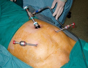 endoskopická operácia