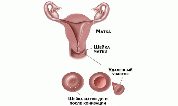 Dlaczego jest i jak traktowany jest ektopowy szyjki macicy