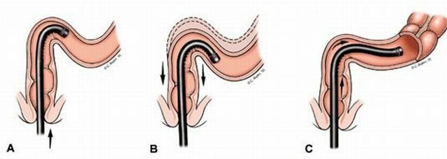 Išankstinė-manoskopija yra modernus proktologinių ligų diagnozavimo metodas