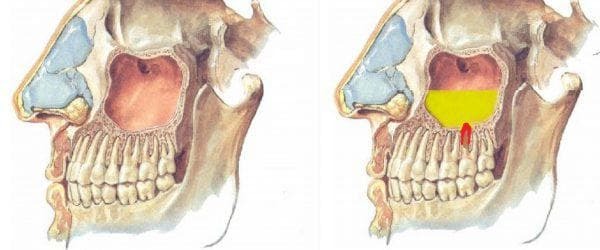 acute odontogene sinusitis