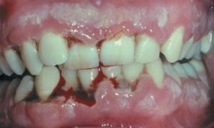 Desmodontosis - penyakit langka dan berbahaya pada jaringan periodontal