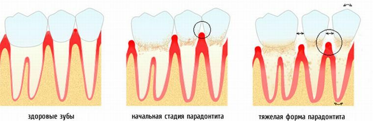 Quatro graus de mobilidade dentária por Entin: classificação e tratamento