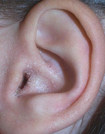 Symptómy a príčiny výskytu ušnej huby u ľudí