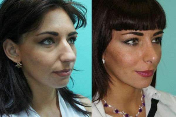 Нос до операции до и после фото