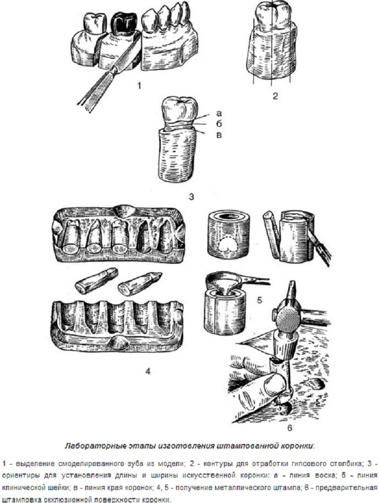 Stamped crowns - et verktøy for beskyttelse og restaurering av tenner