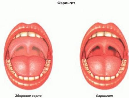 Tekenen van acute en chronische vorm van faryngitis