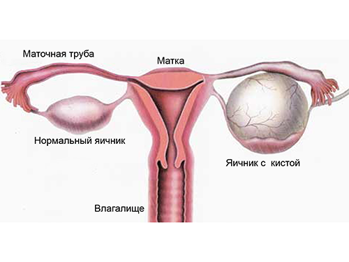 Cisto ovariano com menopausa 1