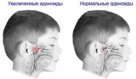 adenoids in children treatment without surgery