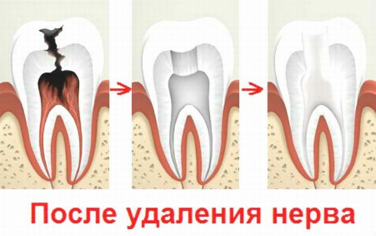 Como matar e remover o nervo do dente e quais complicações são possíveis?