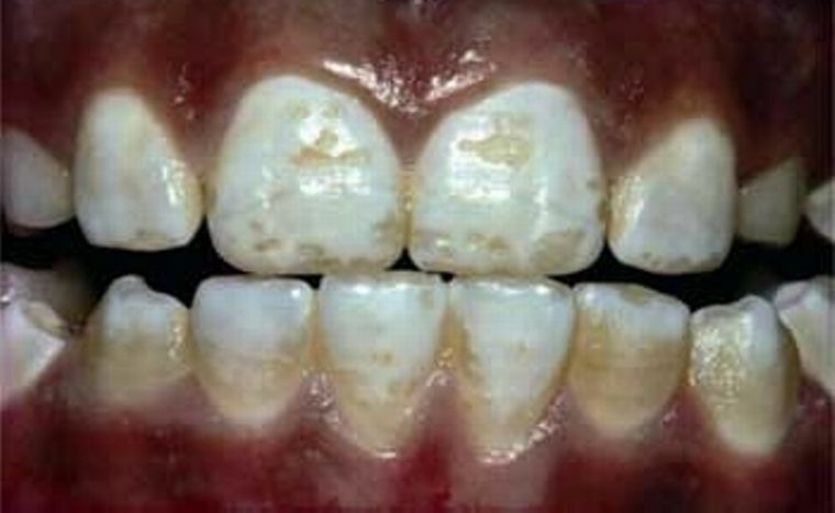 Spotted email of dental fluorosis: oorzaken en behandeling