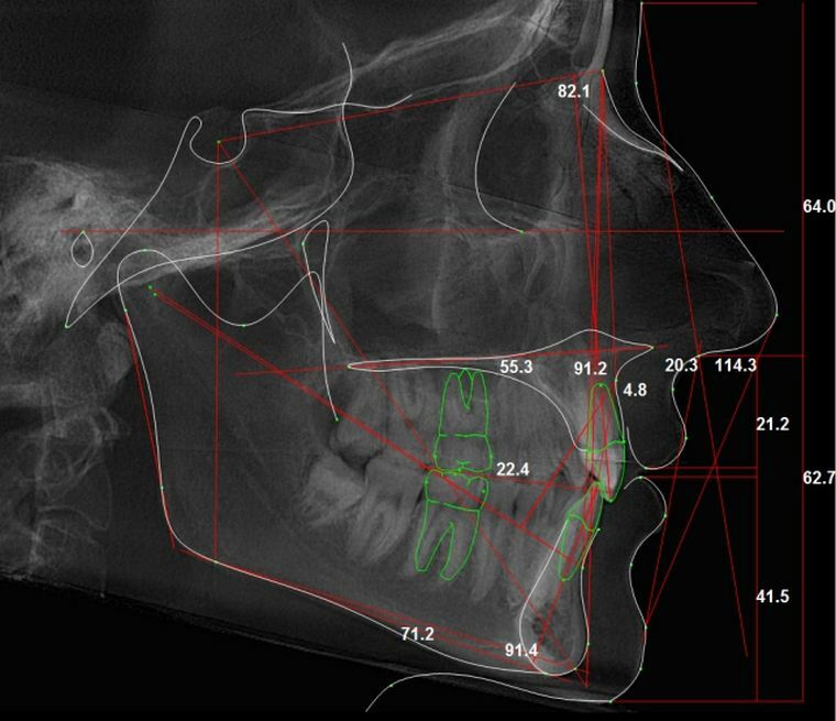 Teleradiografia - por que é levado um tiro axial, lateral e frontal?