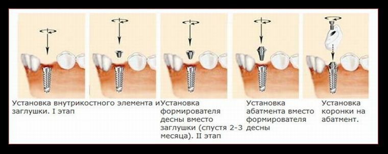 Можно ли вставить. Имплант формирователь абатмент. Формирователь на имплант Osstem. Двухэтапная методика имплантации. Формирователь десны для импланта.