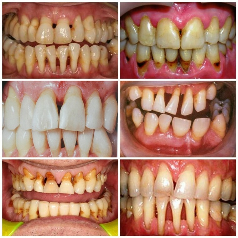 Tratamento da doença periodontal no lar