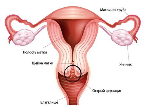 Cervical ectopia of the cervix and chronic cervicitis