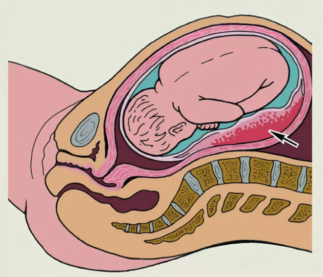 Premature placental abruption: causes, symptoms, treatment
